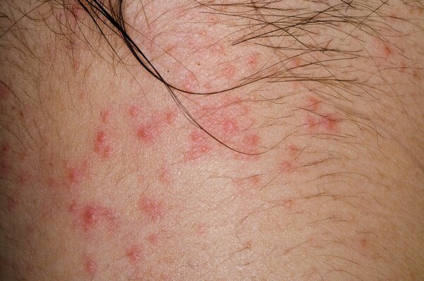 Common Skin Diseases: Symptoms and Treatment Guide