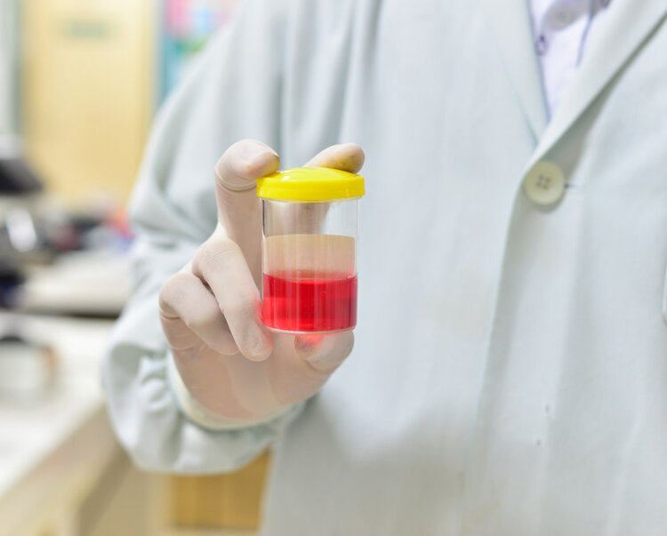 Why is uremia becoming increasingly common? Doctors advise: Avoid these 4 causes, and your kidneys will thank you.