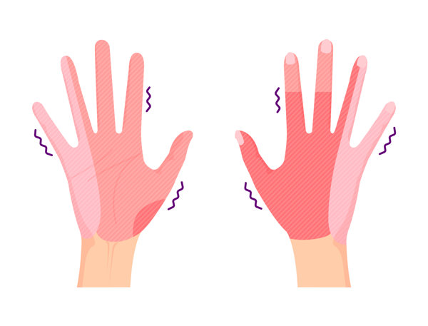 Palmar Hyperhidrosis: Which Doctor to See & Treatment