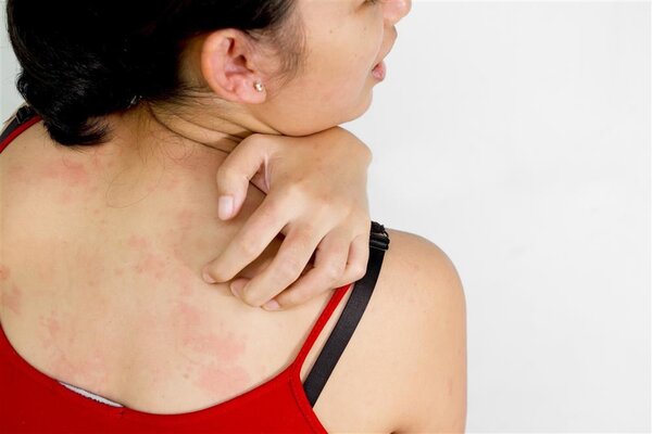 Urticaria Causes: Allergic vs Non-Allergic Mechanisms